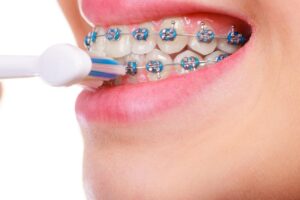 Hướng dẫn cách đánh răng khi niềng răng đúng cách