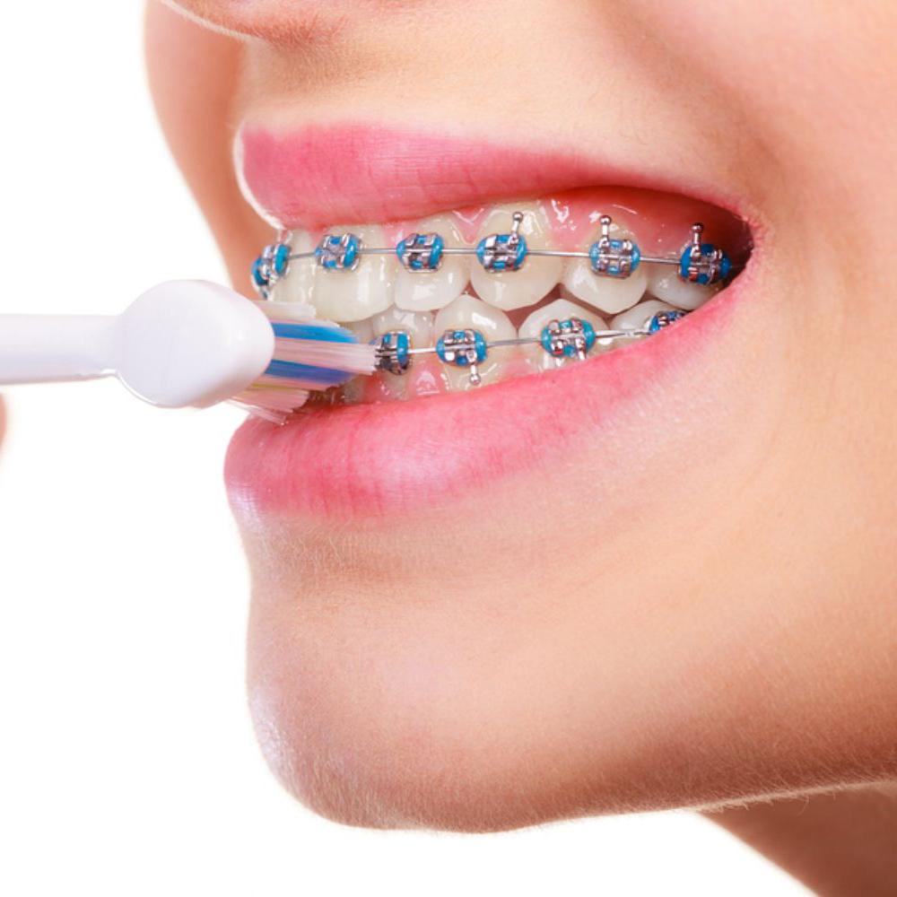 Hướng dẫn cách đánh răng khi niềng răng đúng cách